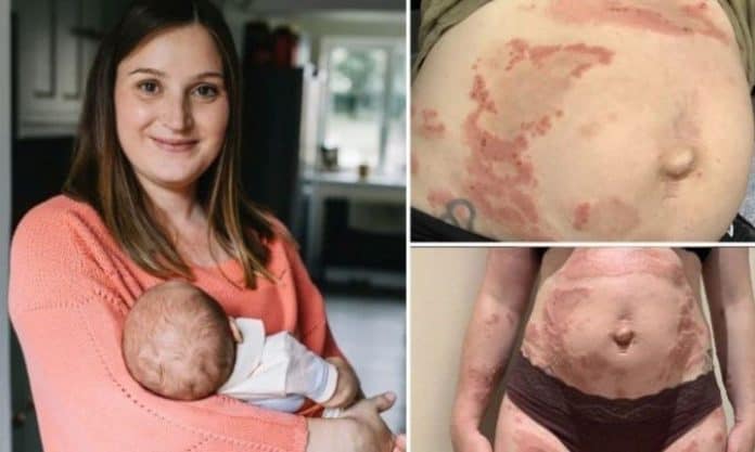 ¡Insólito! Mujer europea es alérgica a su propio hijo