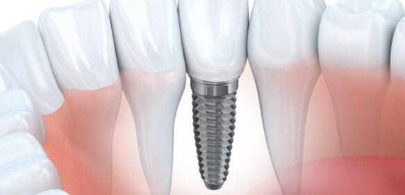 Fundaciones cobraban entre  10 y 20 EUR a extranjeros para hacer implantes sin aval odontológicos
