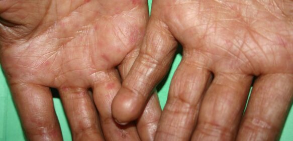 Dermatólogos sostiene que en caso de confirmarse enfermedad de escabiasis en Haití el país cuenta con tratamientos para su cura