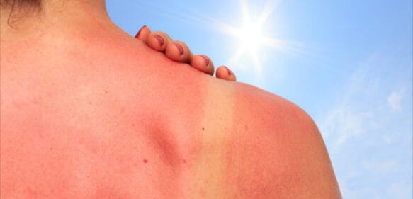 Instituto Dermatológico insta a los dominicanos tomar precauciones al exponerse al sol