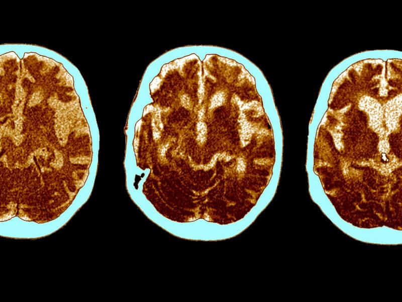El cerebro de los supervivientes de una forma grave de covid-19 envejece 20 años, dice un nuevo estudio