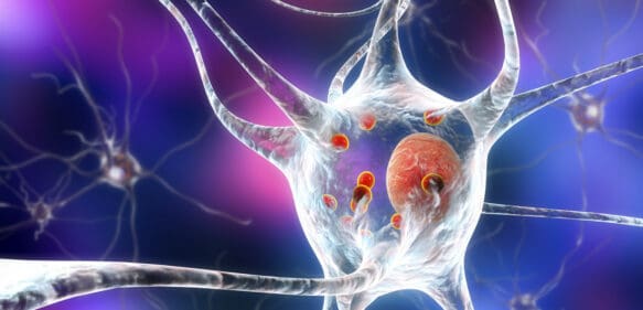 Identifican qué células cerebrales mueren a causa de la enfermedad de Parkinson