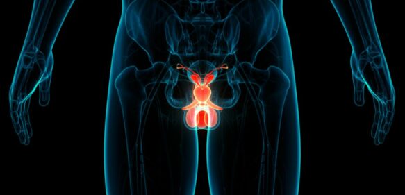 Alrededor del 50% de pacientes con cáncer de próstata nunca han ido a una evaluación por un urólogo, según estudios
