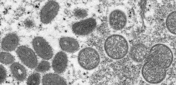 Dos niños son diagnosticados con viruela símica en EEUU