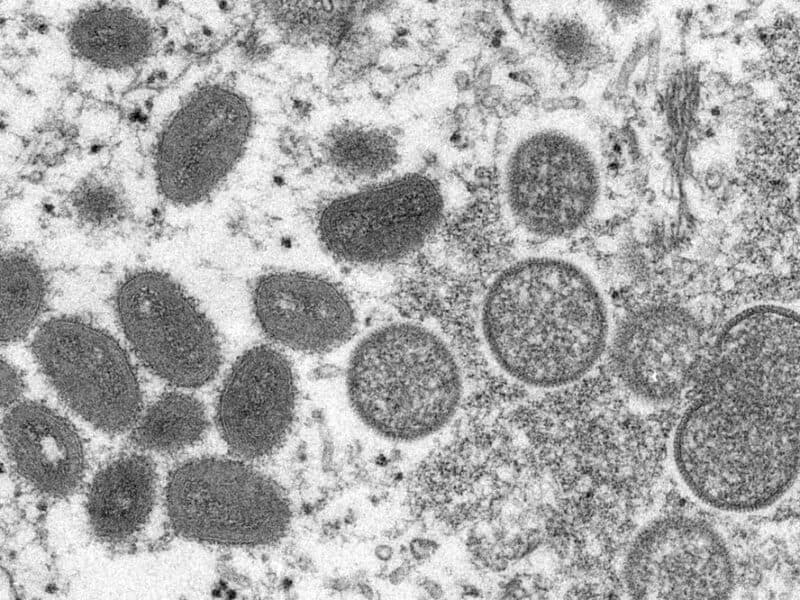 Dos niños son diagnosticados con viruela símica en EEUU