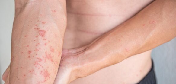 14 de septiembre: Día Mundial de la Dermatitis Atópica