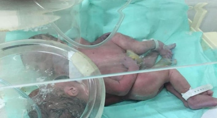 Mujer de 25 años da a luz a bebés siameses en Los Mina; comparten hígado y estómago
