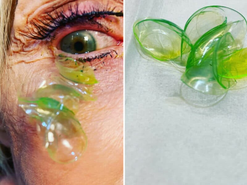 Oftalmóloga remueve 23 lentes de contacto alojadas en el ojo de una anciana