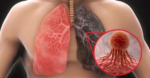 Cáncer de pulmón, el más letal de América Latina, tiene un diagnóstico tardío en 85% de los casos