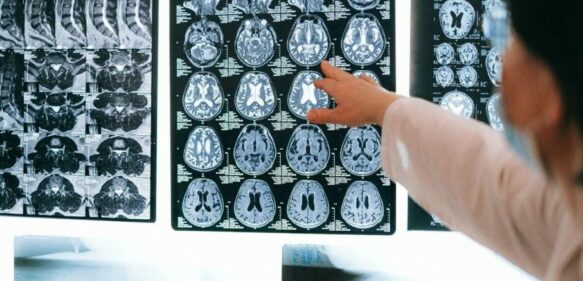 Expertos chinos confirman primer caso de paciente de 19 años con Alzhéimer