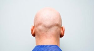 Día Mundial de los Calvos”