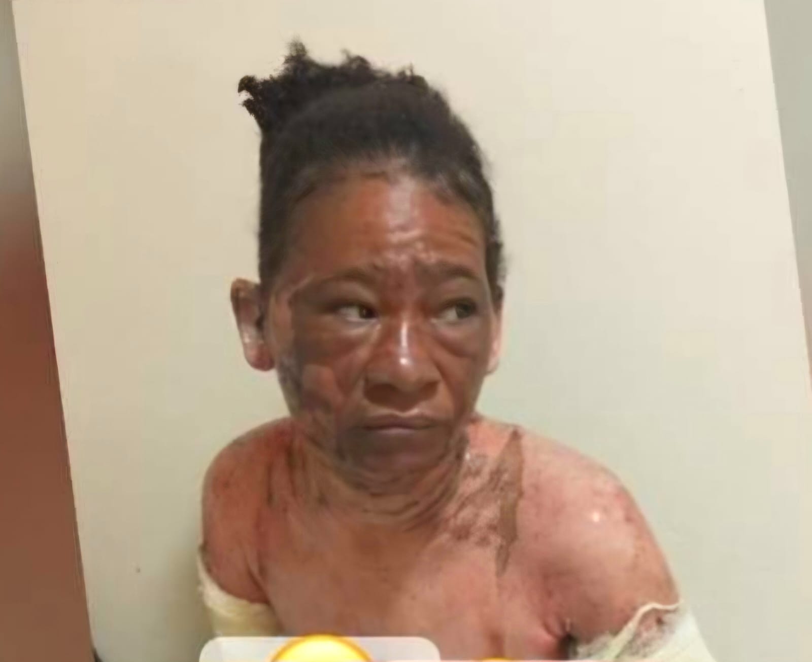 Mujer quema otra con agua caliente en Barahona