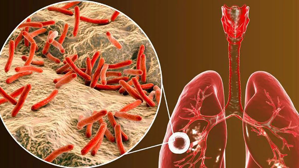 Tuberculosis en once provincias del país