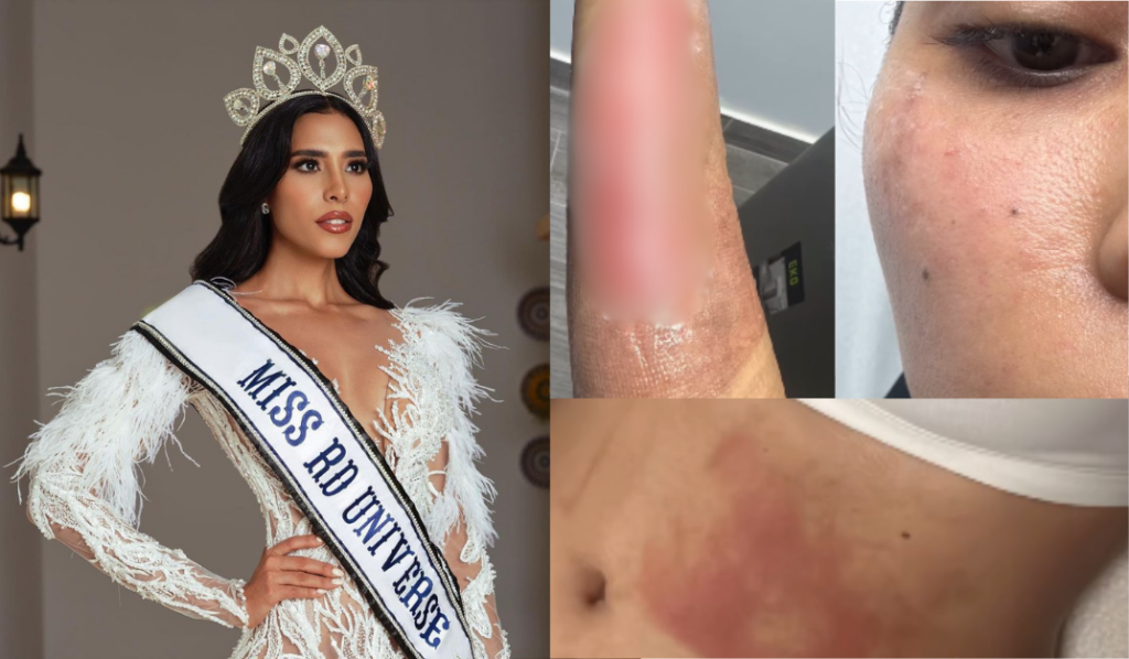 Ex Miss RD narra incidente con olla de presión