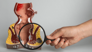 La colonoscopia y la prueba en heces son vitales para detectar el cáncer de colon