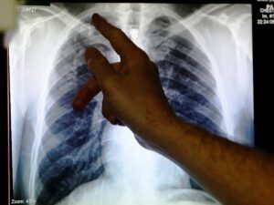 Día Mundial de la Tuberculosis