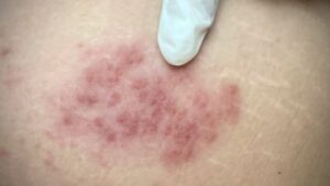 La vacuna contra el herpes zóster podría reducir el riesgo de demencia en personas mayores