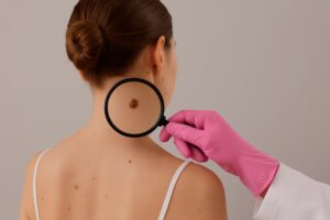 Día Mundial del Melanoma: cuáles son las señales de alerta que pueden detectarse en los lugares menos pensados
