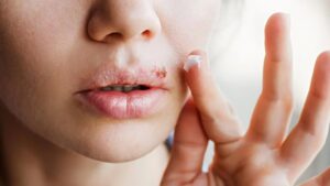 Descubren un vínculo entre el herpes labial y el riesgo de sufrir Alzheimer