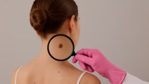 Día Mundial del Cáncer de Piel: cuáles son los síntomas y cómo prevenirlos