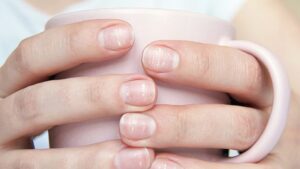 Qué significan las manchas blancas en las uñas