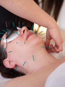 ¿La acupuntura estética es el nuevo bótox de los tratamientos faciales?