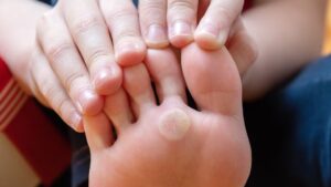 Hongos en los pies: por qué pueden aparecer durante todo el año y cómo prevenirlos