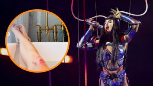Katy Perry mostró sus heridas tras un accidente en el escenario durante su gira Lifetimes Tour