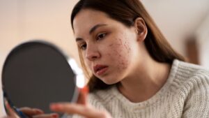 ¿Las microdosis de un medicamento pueden aliviar el acné?