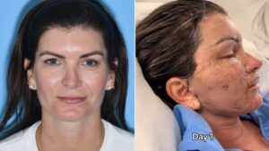 La reflexión de una mujer que gastó 78 mil dólares en un lifting facial: “¿Qué demonios hice?”