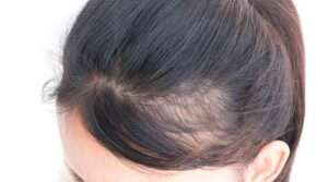 Fármacos y cabello: efectos de la pérdida de peso según especialistas